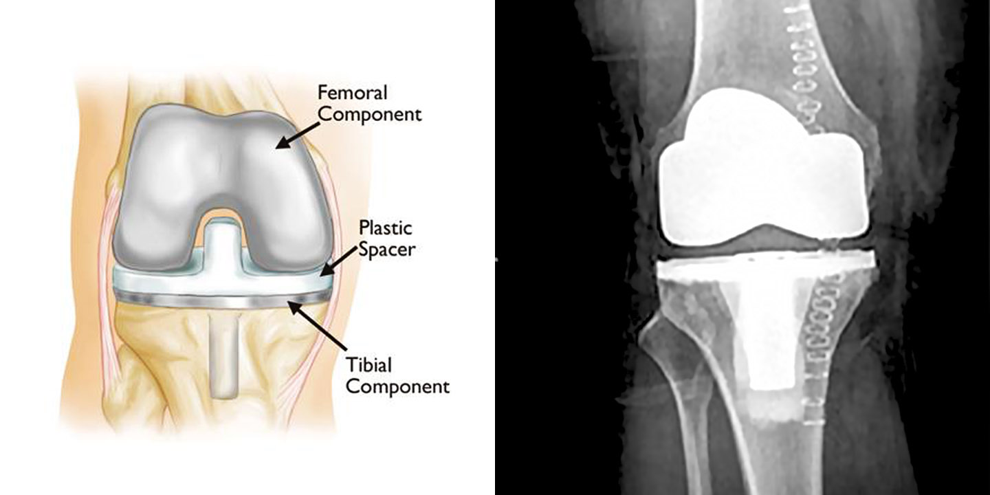 Knee Replacement Chattanooga Center for Joint Replacement and Orthopedics